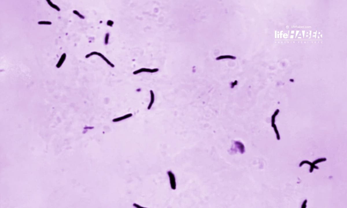 Tüberkülozda Rekor Tanı: 8.3 Milyon Yeni Vaka, Ancak Ölümler Düşüşte (DSÖ Uyardı)